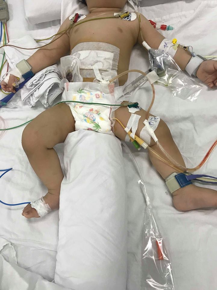 Bé trai 11 tháng tuổi bị mẹ ruột dùng dao đâm nhiều nhát vào bụng nguy kịch