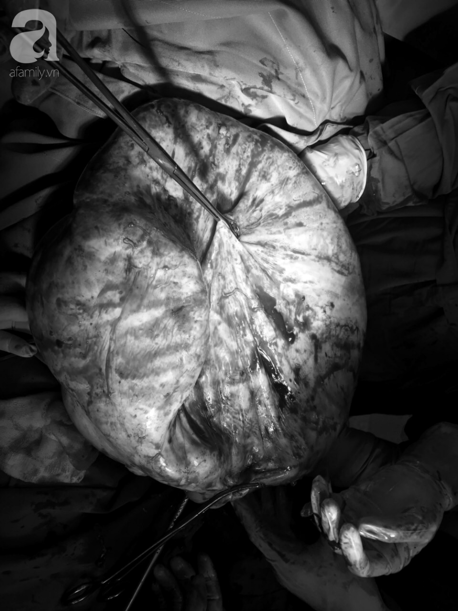 Thường xuyên ăn đêm, cô gái 20 tuổi nghĩ mình béo bụng chủ quan không đi khám suýt chết vì mang u buồng trứng khổng lồ