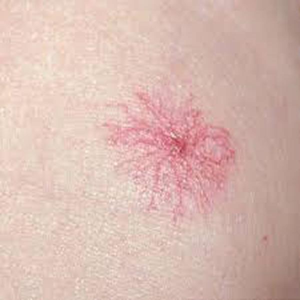 Tưởng vết muỗi đốt trên người, nam thanh niên may mắn thoát nạn khi sớm nghe lời bạn gái