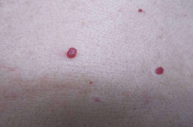 Tưởng vết muỗi đốt trên người, nam thanh niên may mắn thoát nạn khi sớm nghe lời bạn gái