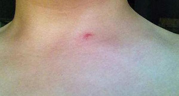 Tưởng vết muỗi đốt trên người, nam thanh niên may mắn thoát nạn khi sớm nghe lời bạn gái