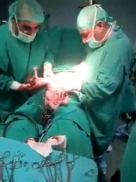 Hiếm thấy: Clip sinh mổ khiến các bác sĩ trong nghề lẫn người xem nín thở vì đếm mãi không hết số thai nhi