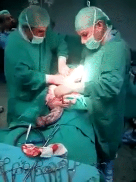 Hiếm thấy: Clip sinh mổ khiến các bác sĩ trong nghề lẫn người xem nín thở vì đếm mãi không hết số thai nhi