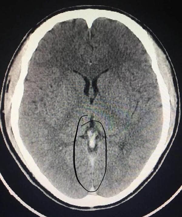 Nhìn phim chụp X-quang, chàng trai giật mình biết được lý do mình đau đầu không hề đơn giản
