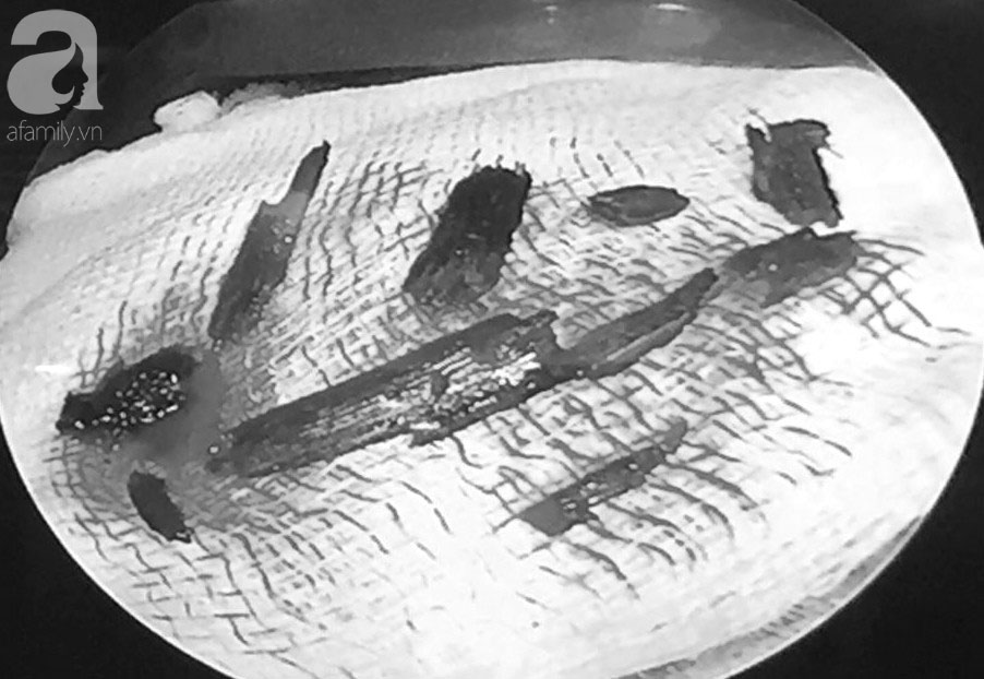 Người đàn ông An Giang bị hàng chục mảnh gỗ ghim vào hốc mắt vì ngã xe đập mặt xuống đường