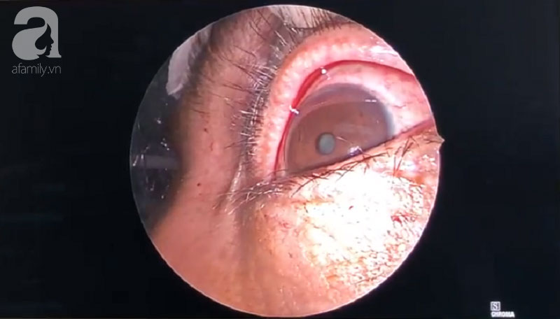 Người đàn ông An Giang bị hàng chục mảnh gỗ ghim vào hốc mắt vì ngã xe đập mặt xuống đường