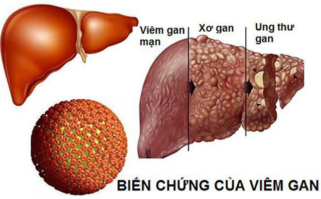Căn bệnh nguy hiểm có thể dẫn đến ung thư gan: Tốn 400 triệu vẫn không chữa được