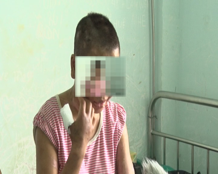 Đi làm thuê, bị chủ đánh đập biến dạng đến mẹ đẻ nhận không ra