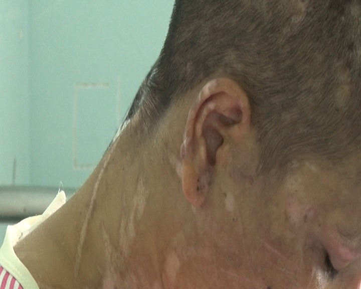 Đi làm thuê, bị chủ đánh đập biến dạng đến mẹ đẻ nhận không ra