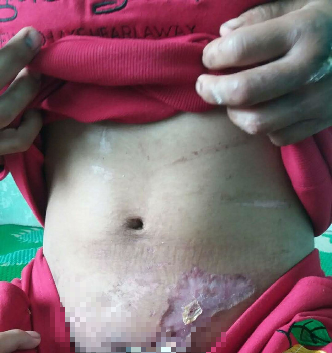 Vụ cô gái nghi bị tra tấn dã man: Sau nửa tháng đánh đập, nạn nhân phát hiện bị sẩy thai