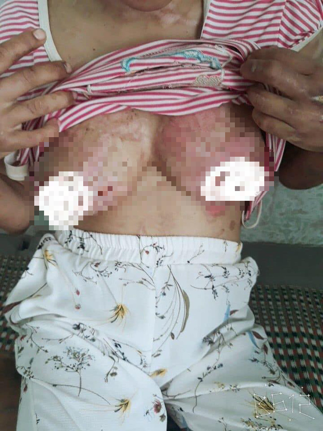 Vụ cô gái nghi bị tra tấn dã man: Sau nửa tháng đánh đập, nạn nhân phát hiện bị sẩy thai