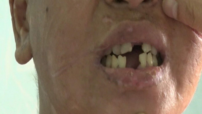 Vụ cô gái nghi bị tra tấn dã man: Sau nửa tháng đánh đập, nạn nhân phát hiện bị sẩy thai