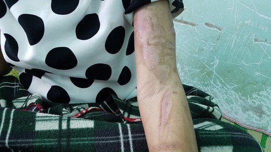 Lời kể rùng rợn của cô gái nghi bị chủ tra tấn dã man