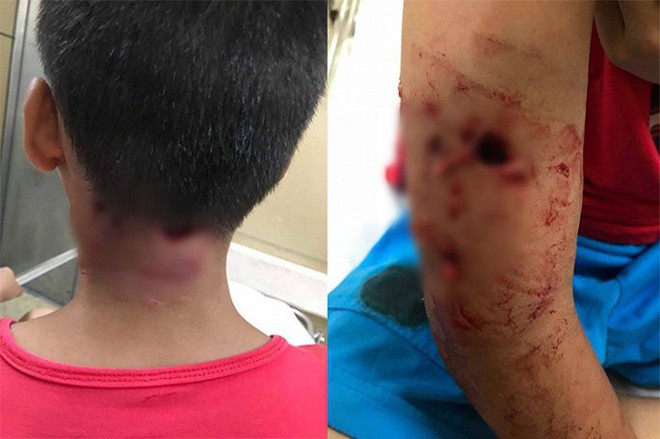 Thêm một bé trai bị chó cắn thủng tay và gáy khi cho chó ăn