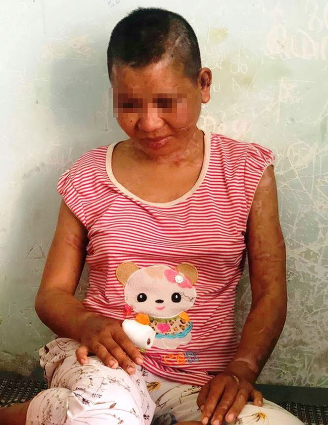 Hành trình tháo chạy khỏi địa ngục của nữ 9X bị tra tấn tàn bạo