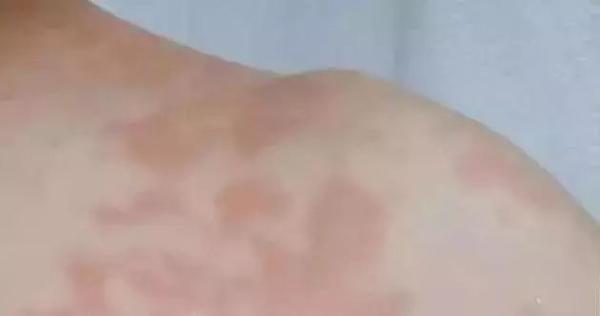 Chân bỗng nhiên đau nhói, ngứa ngáy, người đàn ông chỉ kịp nói một câu rồi nhập viện