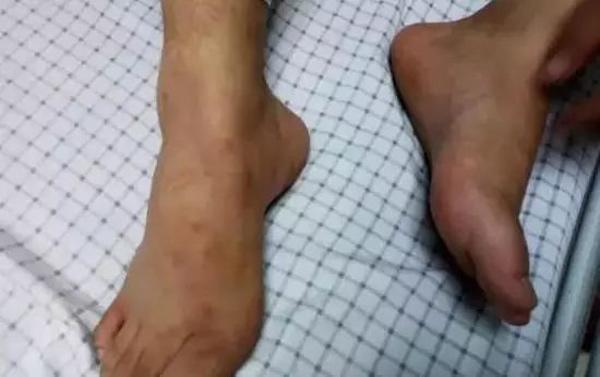 Chân bỗng nhiên đau nhói, ngứa ngáy, người đàn ông chỉ kịp nói một câu rồi nhập viện