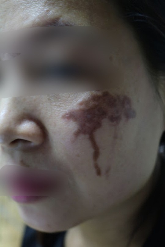 Mặt loang lổ sạm đen vì chấm axit chữa nám da