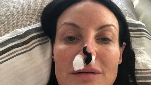 Để đỉa hút máu cứu chiếc mũi phẫu thuật thẩm mỹ hỏng