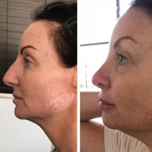 Để đỉa hút máu cứu chiếc mũi phẫu thuật thẩm mỹ hỏng