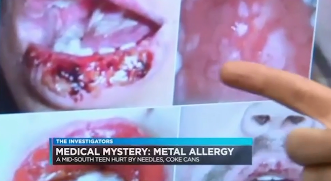 Rùng mình trước những tai nạn niềng răng đáng sợ trên thế giới