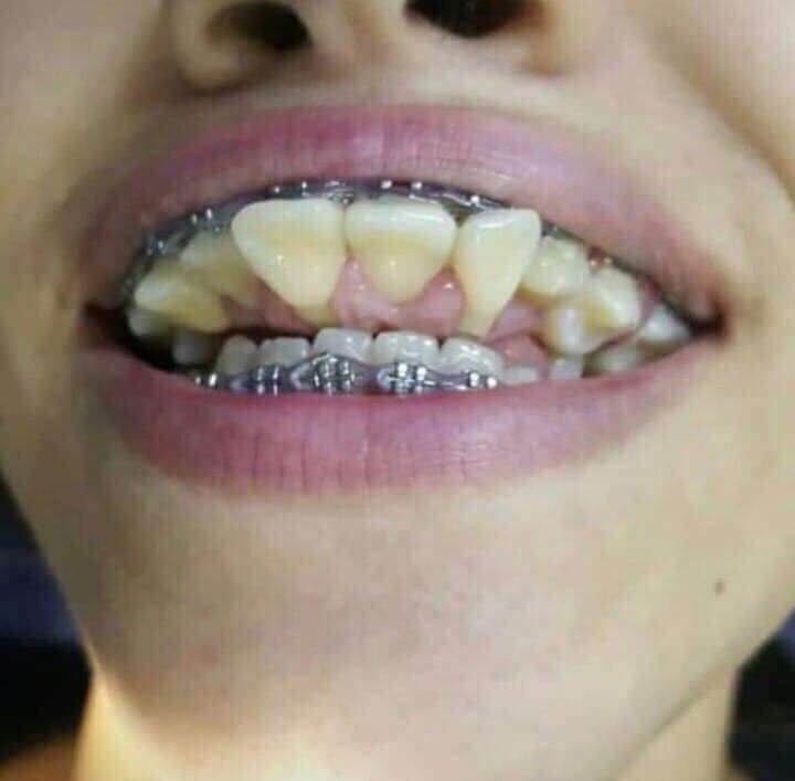 Rùng mình trước những tai nạn niềng răng đáng sợ trên thế giới Rùng mình trước những tai nạn niềng răng đáng sợ trên thế giới
