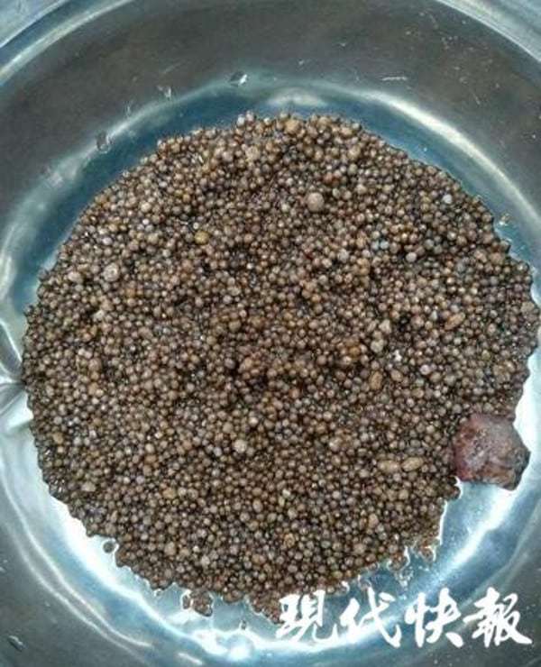 Bác sĩ sốc khi lấy ra gần 3.000 viên sỏi trong thận bệnh nhân