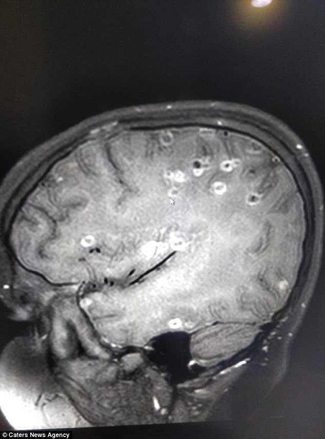 Bé 8 tuổi co giật vì 100 trứng sán làm tổ trong não, nguyên nhân do 2 thói quen nhiều người mắc