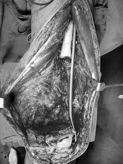 Chủ quan không cho con đi khám sớm, mẹ đau đớn khi phát hiện con bị ung thư xương