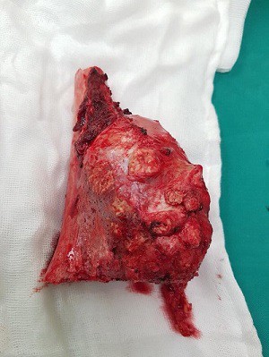 Chủ quan không cho con đi khám sớm, mẹ đau đớn khi phát hiện con bị ung thư xương