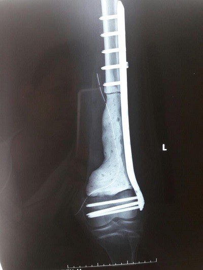 Chủ quan không cho con đi khám sớm, mẹ đau đớn khi phát hiện con bị ung thư xương