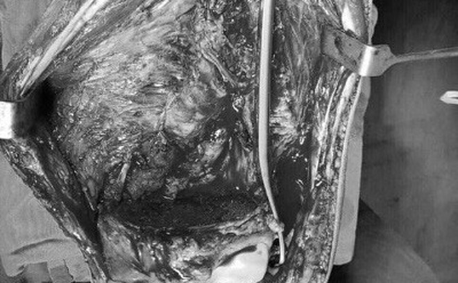 Chủ quan không cho con đi khám sớm, mẹ đau đớn khi phát hiện con bị ung thư xương