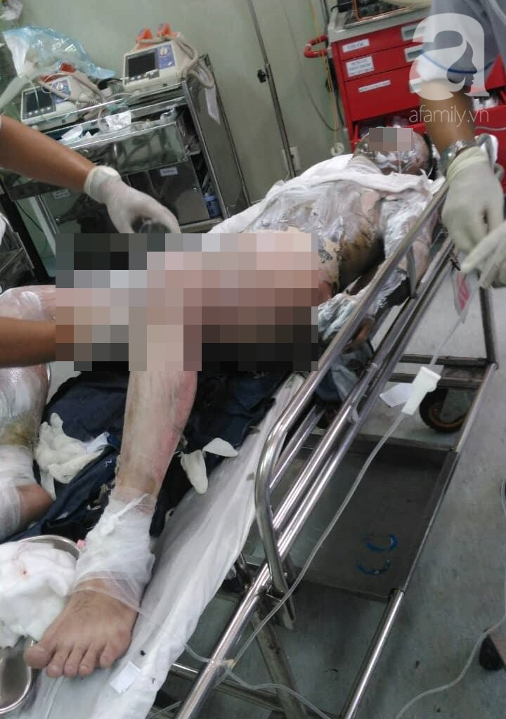 Ghen tuông, vợ dùng dầu hôi đốt chồng cháy đen, bỏng đến 90% cơ thể