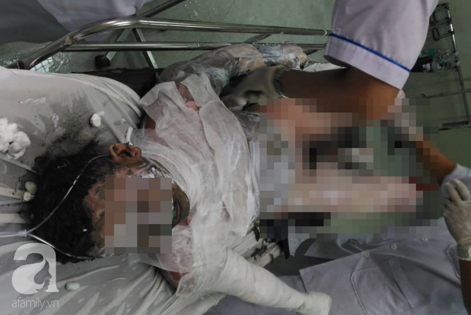 Ghen tuông, vợ dùng dầu hôi đốt chồng cháy đen, bỏng đến 90% cơ thể