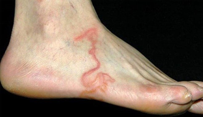 Từ 1 thói quen khi đi biển ai cũng từng làm: Chuyên gia cảnh báo về khả năng bị nhiễm loại kí sinh trùng nguy hiểm