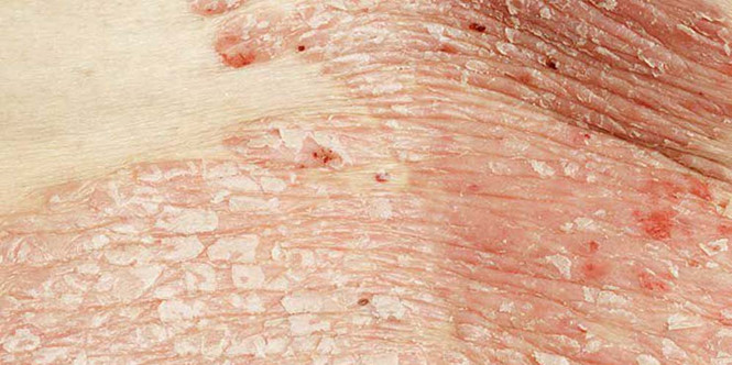 Chế độ ăn lành mạnh giúp giảm nhẹ bệnh vẩy nến