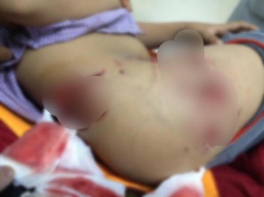 2 bé trai bị chó cắn thương tâm, sâu tận xương