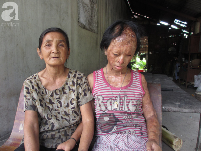 Bà nội bé gái bị tạt axit năm 7 tuổi vì mẹ giật chồng người khác rồi bỏ rơi đã đến TP.HCM để xin đôi mắt tử tù cứu cháu