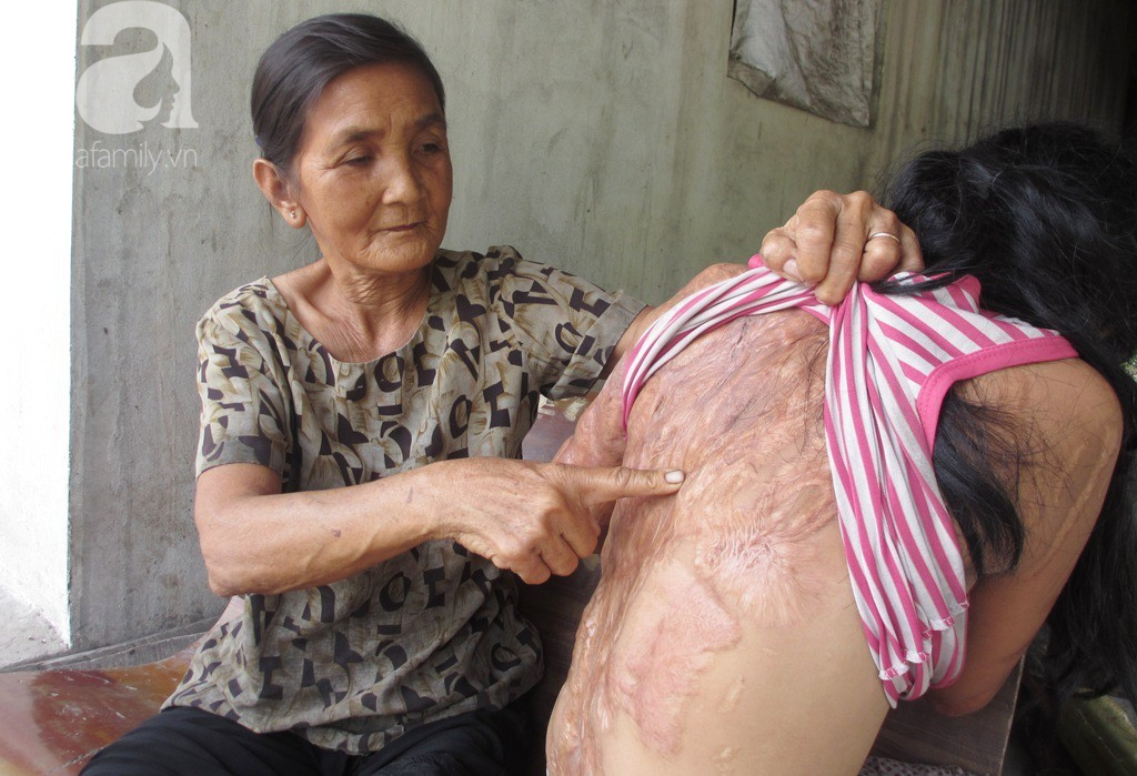 Bà nội bé gái bị tạt axit năm 7 tuổi vì mẹ giật chồng người khác rồi bỏ rơi đã đến TP.HCM để xin đôi mắt tử tù cứu cháu