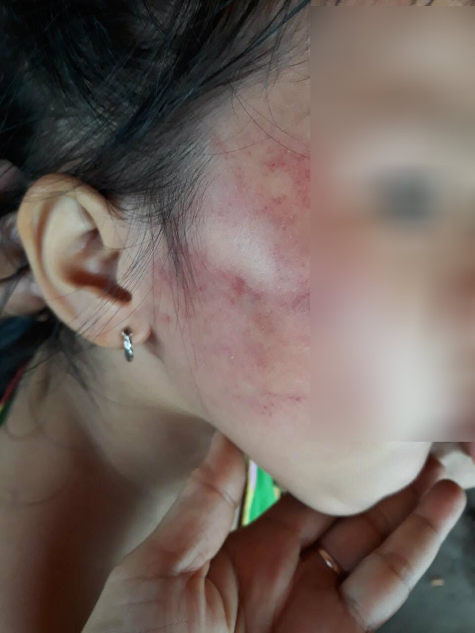 Vụ bé gái 5 tuổi bị cô giáo tát: Phát hiện cục máu trong tai bé, gia đình gửi đơn tới Hội Bảo vệ Quyền trẻ em TP.HCM