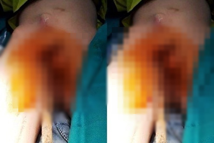 Nhảy từ trên tường xuống dưới, bé trai 6 tuổi bị thanh sắt đâm xuyên qua người