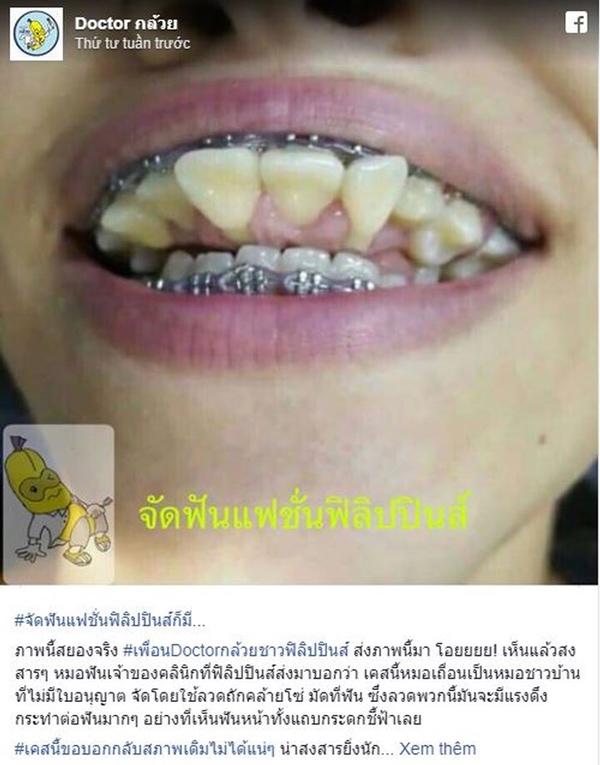 Xôn xao hàm răng chổng ngược khiến ai cũng hoảng hốt, biết lý do lại càng đau lòng