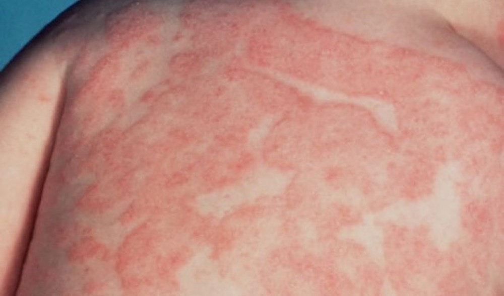 Đã có trường hợp tử vong do kiến lửa đốt, hãy làm theo hướng dẫn này để sơ cứu kịp thời