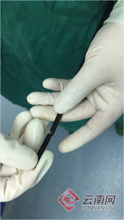 Ngã từ trên ghế xuống khi đang ăn cơm, bé gái 3 tuổi bị đũa cắm vào họng