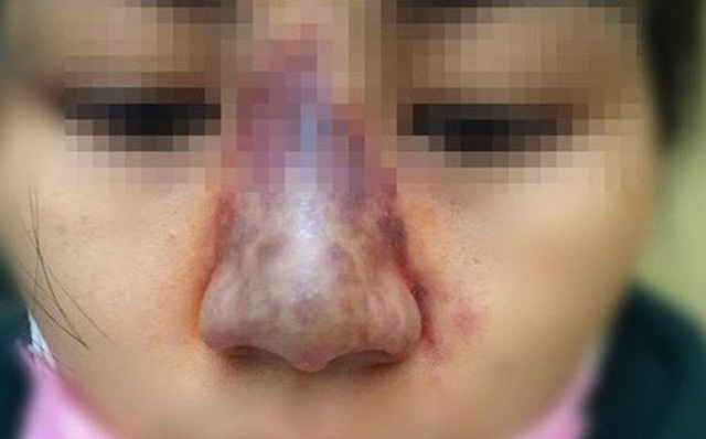 Làm đẹp bằng tiêm chất làm đầy (filler): Tai biến nguy hiểm, khó hồi phục Làm đẹp bằng tiêm chất làm đầy (filler): Tai biến nguy hiểm, khó hồi phục