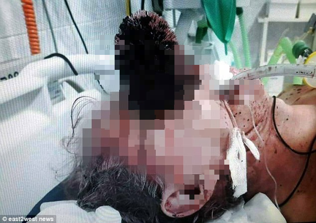 Nga: Trượt ngã trong nhà vệ sinh, người đàn ông bị cái bàn chải đâm vào mặt dẫn đến tử vong