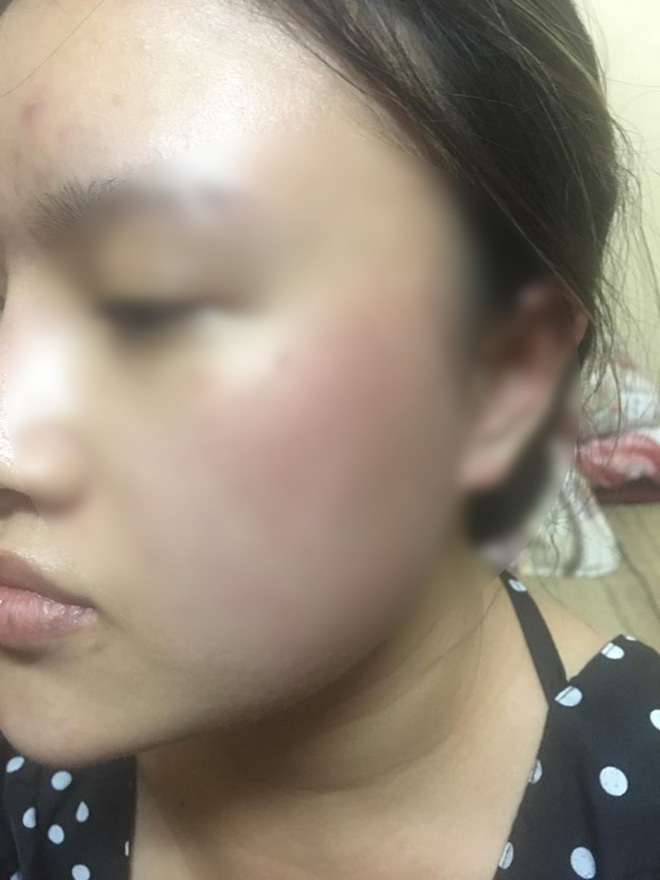 Nữ sinh bị nam chủ nhà tát, đuổi ra khỏi nhà trọ lên tiếng: Nhiều lần tôi còn cho hai vợ chồng ấy vay tiền, mượn xe...