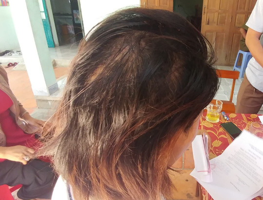 Sắp ly hôn, chồng dùng cuốc cuốc thẳng vào đầu vợ