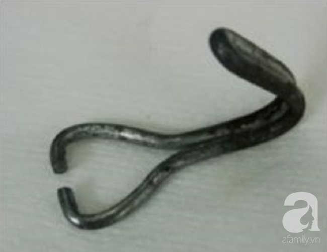 Nghệ An: Cầm móc sắt chơi rồi nuốt vào miệng, bé trai 26 tháng tuổi thủng thực quản