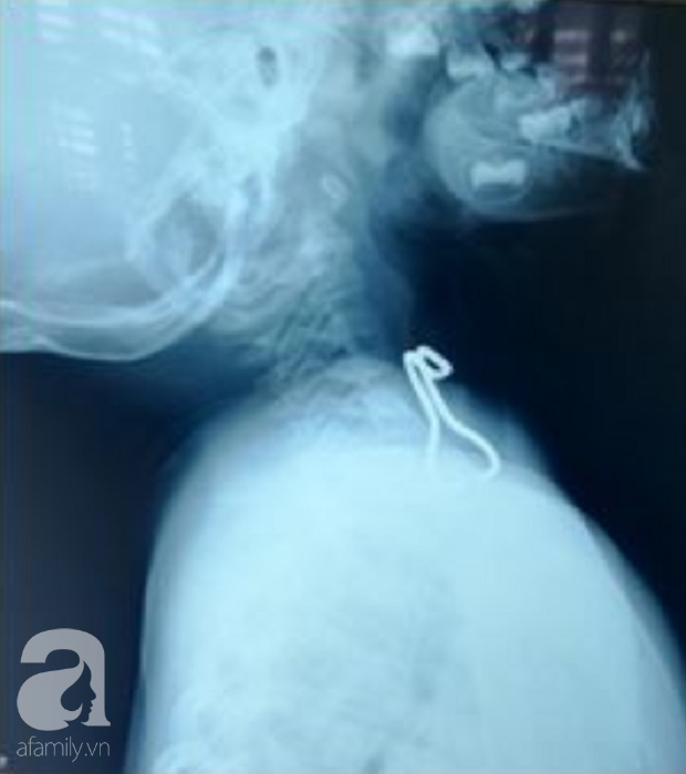 Nghệ An: Cầm móc sắt chơi rồi nuốt vào miệng, bé trai 26 tháng tuổi thủng thực quản